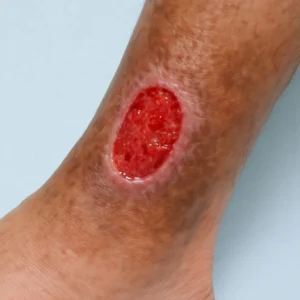 Chronic Venous Insufficiency (CVI) - A 2025 Guide to Relief, Recovery & Prevention 3 Chronic Venous Insufficiency (CVI) - Medical Image of Venous Leg Ulcer